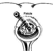 http://www.fascrs.org/global/images/migrated/fistula.gif