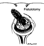 http://www.fascrs.org/global/images/migrated/fistulotomy.gif