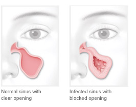 normal versus blocked sinus opening